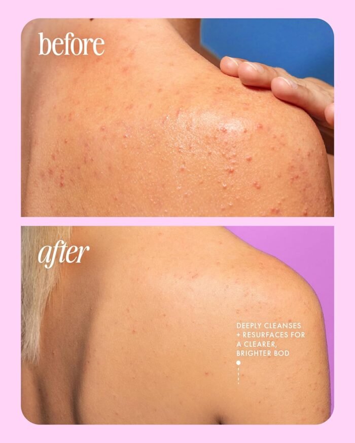 Truly Beauty Cherry Jelly Body Acne Wash - Image 8